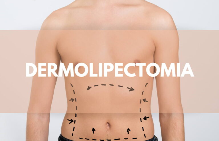 Dermolipectomia: solução para uma pele firme e livre de celulite